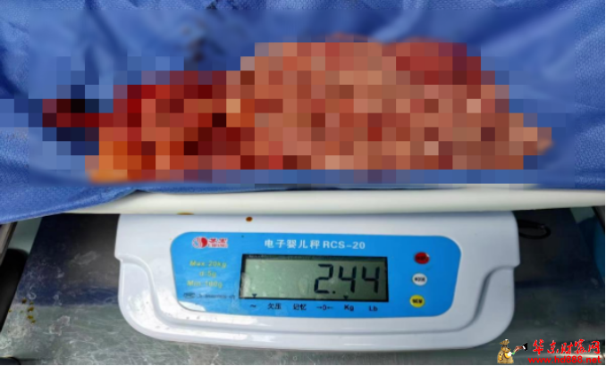 近5斤！阜陽一女子肚中取出...市婦女兒童醫(yī)院醫(yī)生緊急提醒